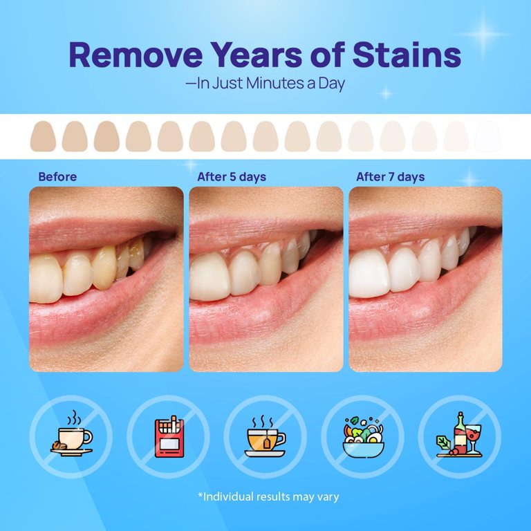 Eloura Teeth Whitening Stripes